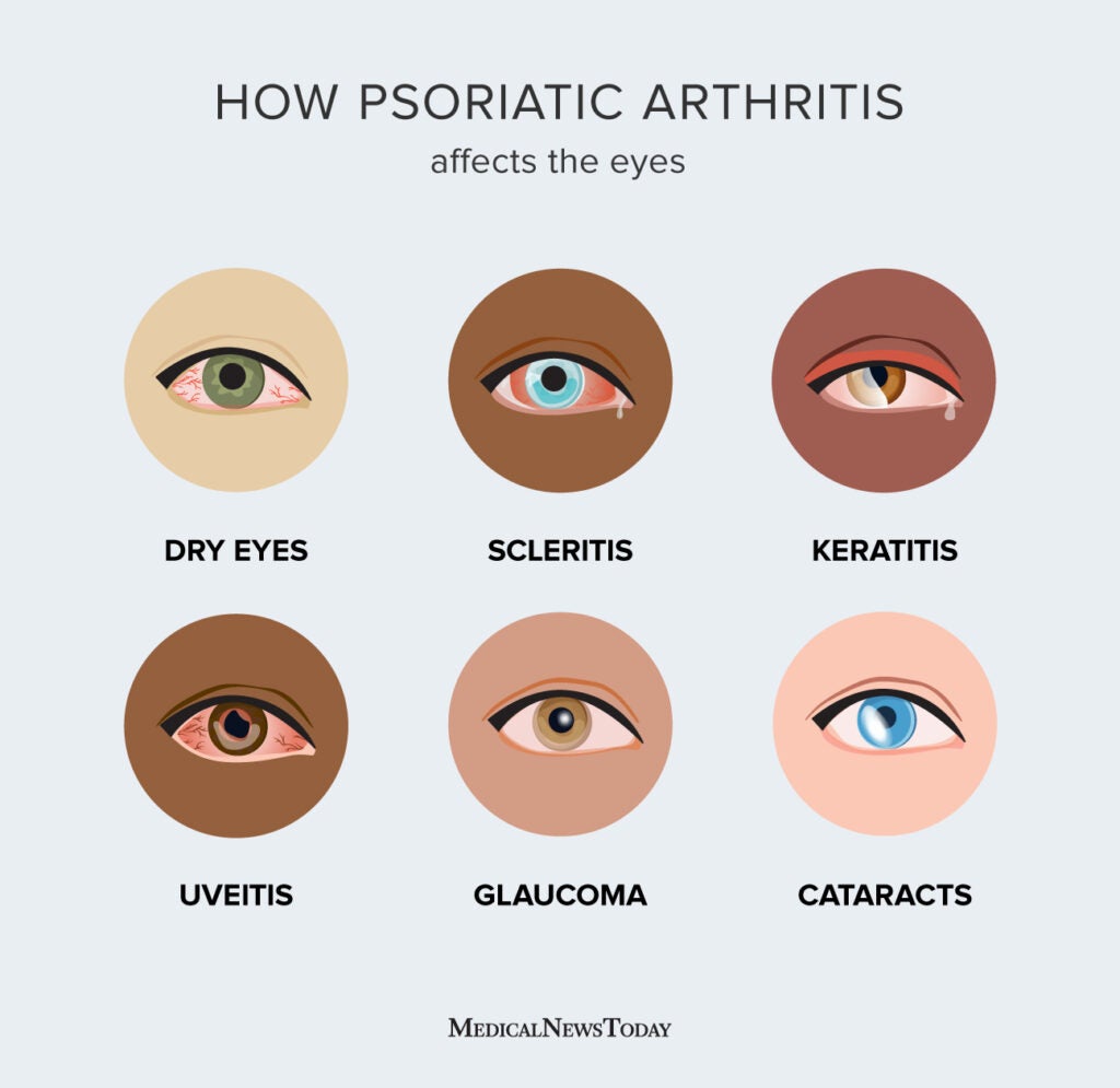 Psoriatic arthritis and eye problems When to seek help